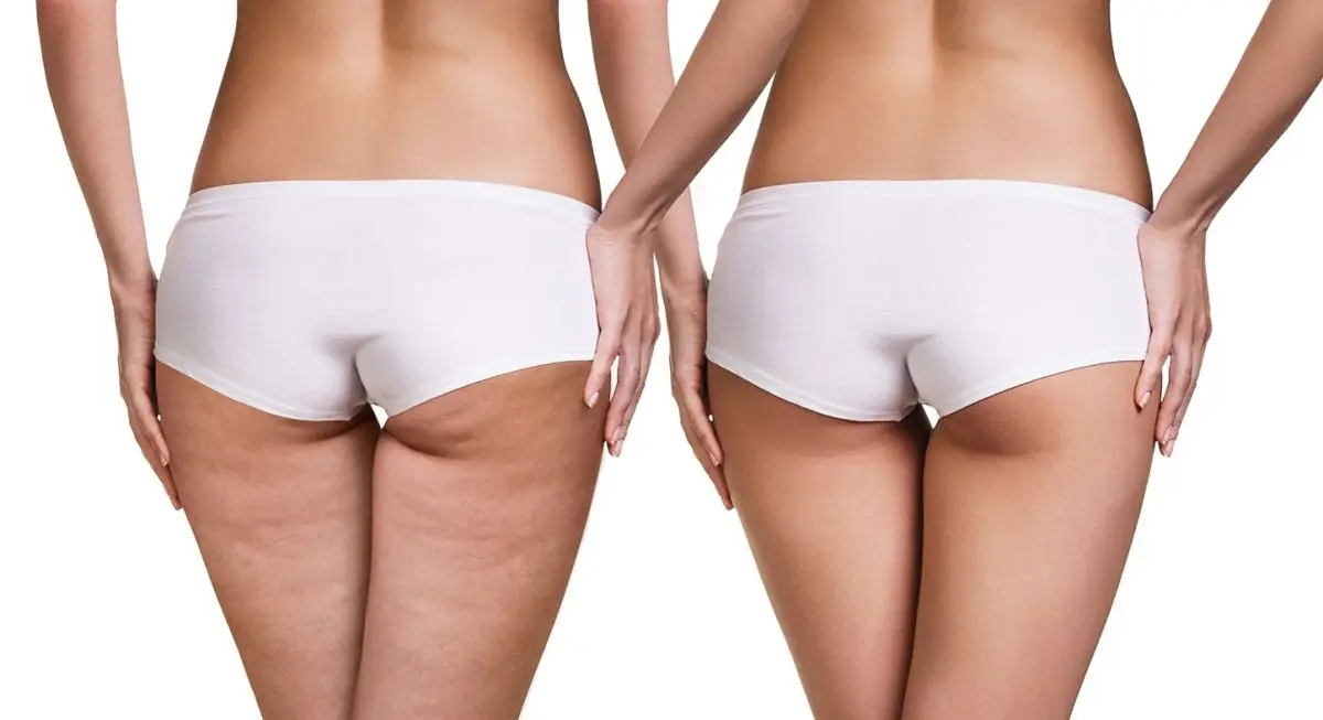 Cellulite &#8211; Sites of interest