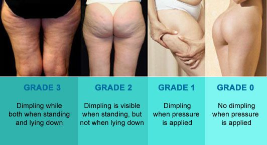 Cellulite stages and how to get rid of it