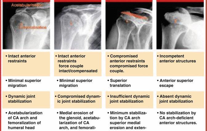 Centered or eccentric omarthrosis, what is it?