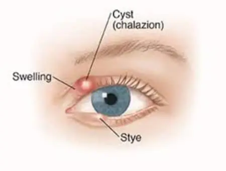 Chalazion &#8211; Causes, Symptoms, Treatment