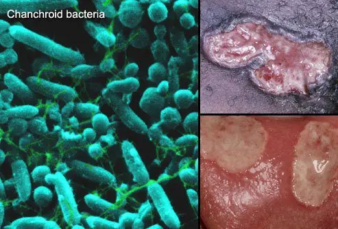 Chancroid: a sexually transmitted disease