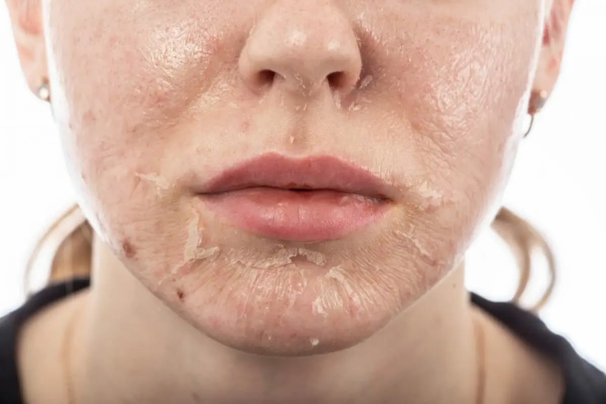 Chemical peeling of the face