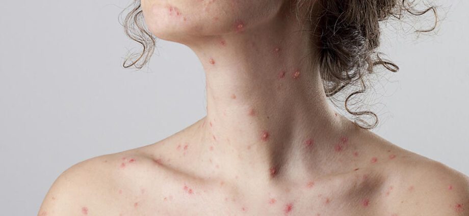 Chickenpox during pregnancy: consequences, is it dangerous, who had chickenpox