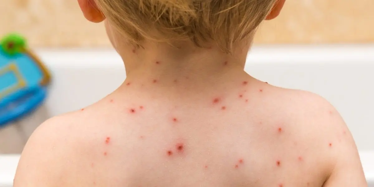 Chickenpox &#8211; Our doctor&#8217;s opinion