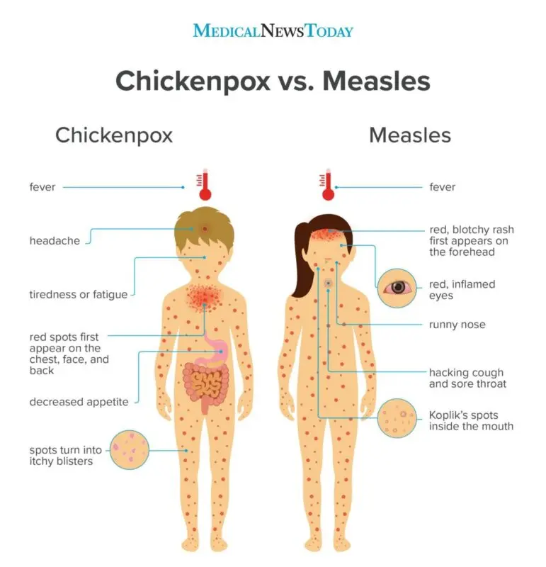 Measles symptoms in children and adults, how to recognize measles