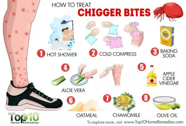 Chigger bite: how to relieve it?