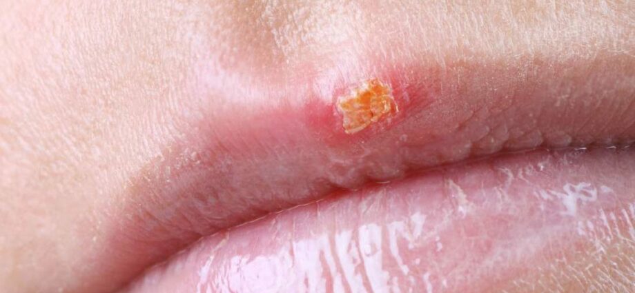 Childhood herpes: why is it contagious?