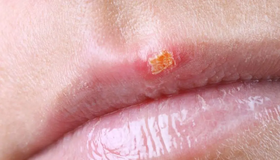 Childhood herpes: why is it contagious?