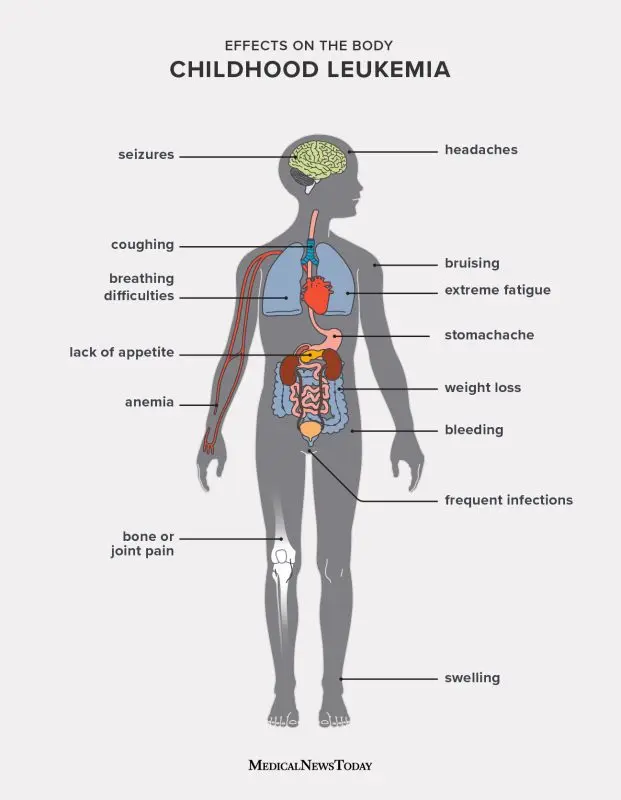 Childhood leukemia: causes, symptoms and treatments