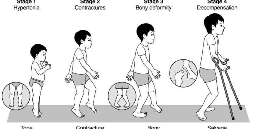 Children with musculoskeletal disorders: features, development