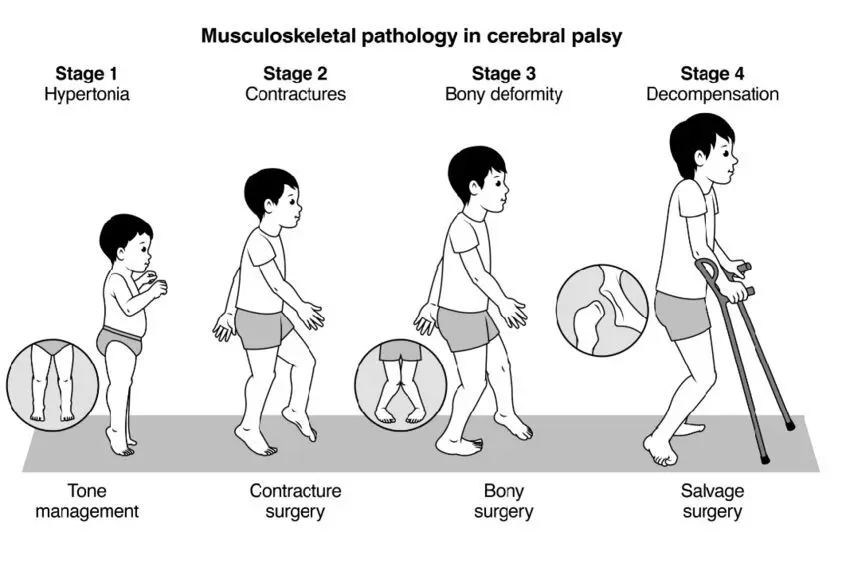 Children with musculoskeletal disorders: features, development