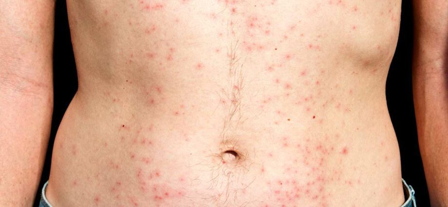 Alergija na klor: uzroci, simptomi i liječenje