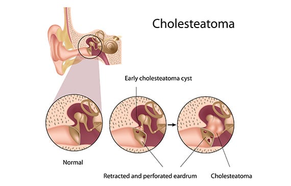 Cholesteatoma: qeexida iyo dib u eegista caabuqan