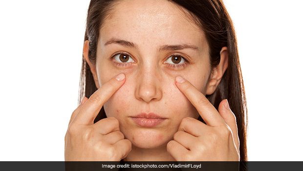 Circles under the eyes: how to deal with eyelid puffiness. Video