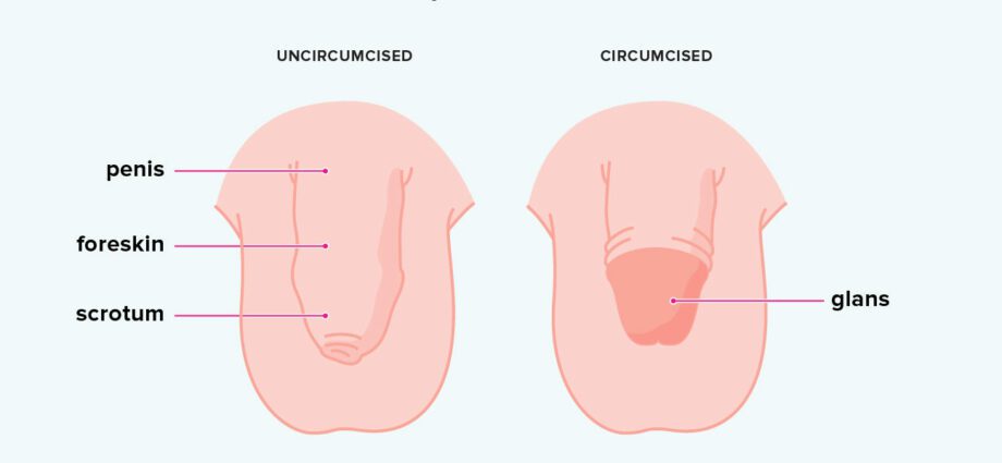 Circumcision: all you need to know about baby circumcision