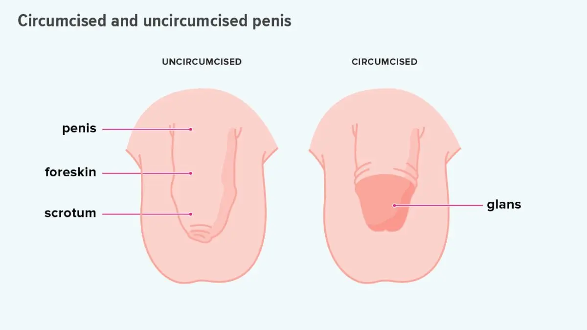 Circumcision: all you need to know about baby circumcision