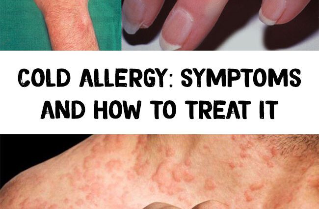 Cold allergy: how to fight, how to treat