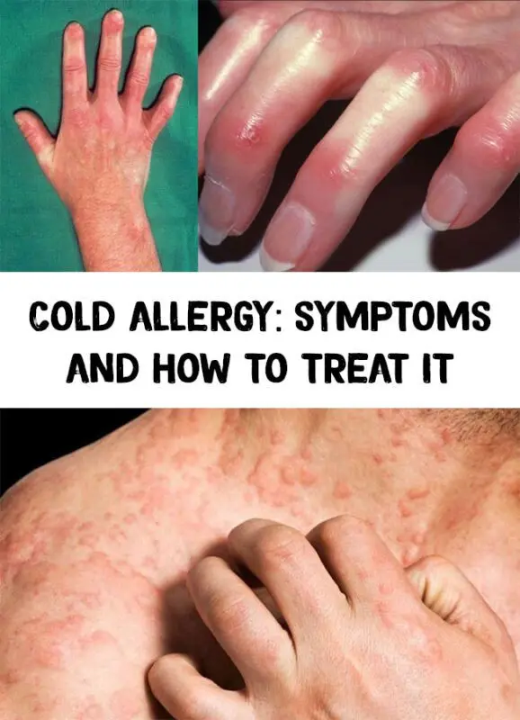 Cold allergy: how to fight, how to treat