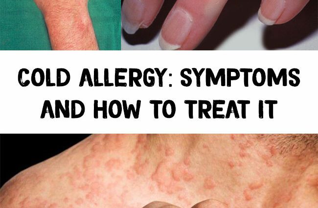 Cold allergy: symptoms and treatment