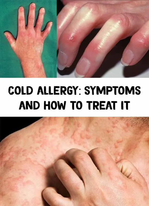 Cold allergy: symptoms and treatment