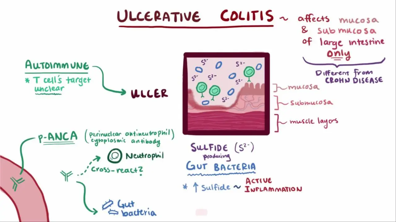 Colitis: all about acute colitis and chronic colitis