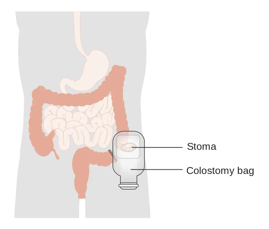 Colostomy