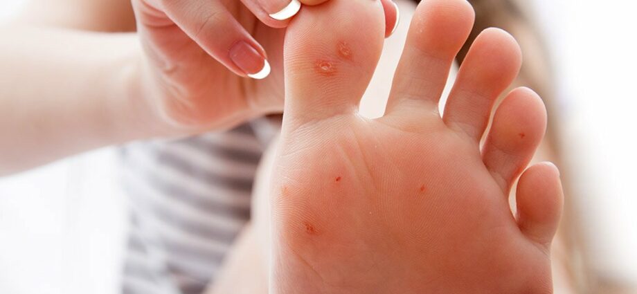 Common and plantar warts &#8211; Our doctor&#8217;s opinion