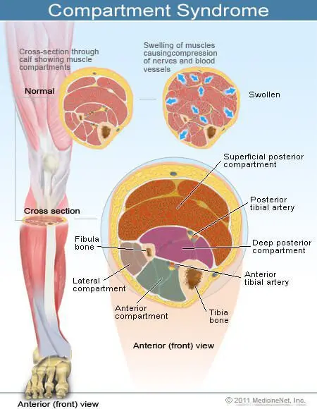 Compartment syndrome