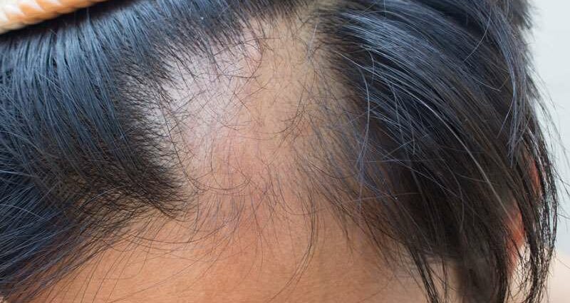 I-Alopecia areata: izindlela ezihambisanayo