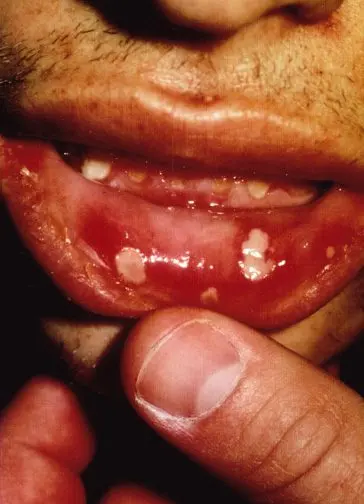 Complementary approaches to canker sores