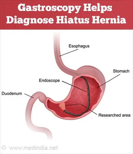 Complementary approaches to hiatus hernia