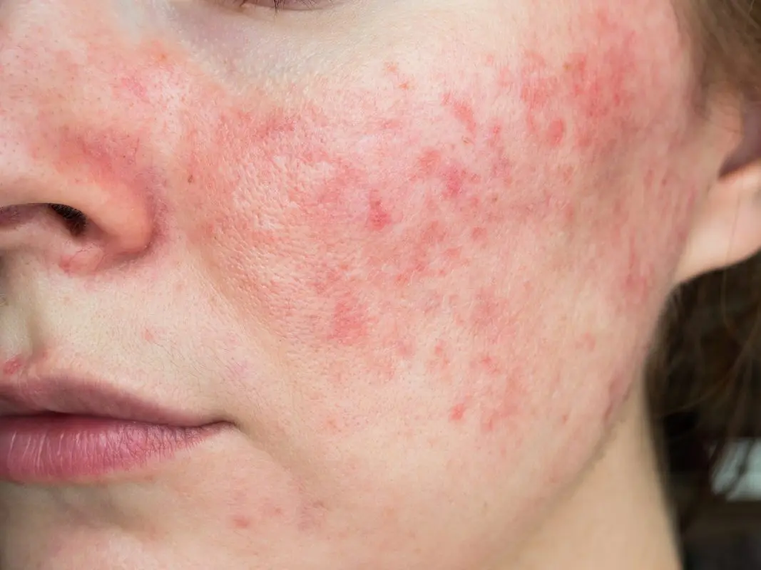 Complementary approaches to rosacea