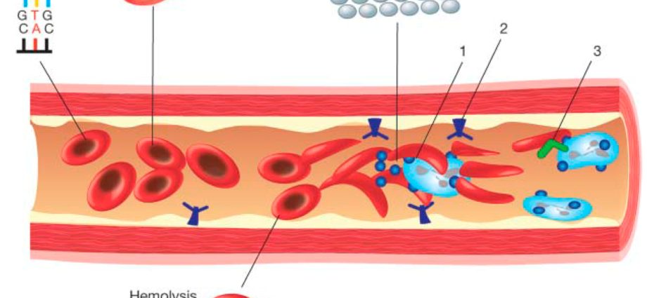 鎌状赤血球貧血への補完的アプローチ