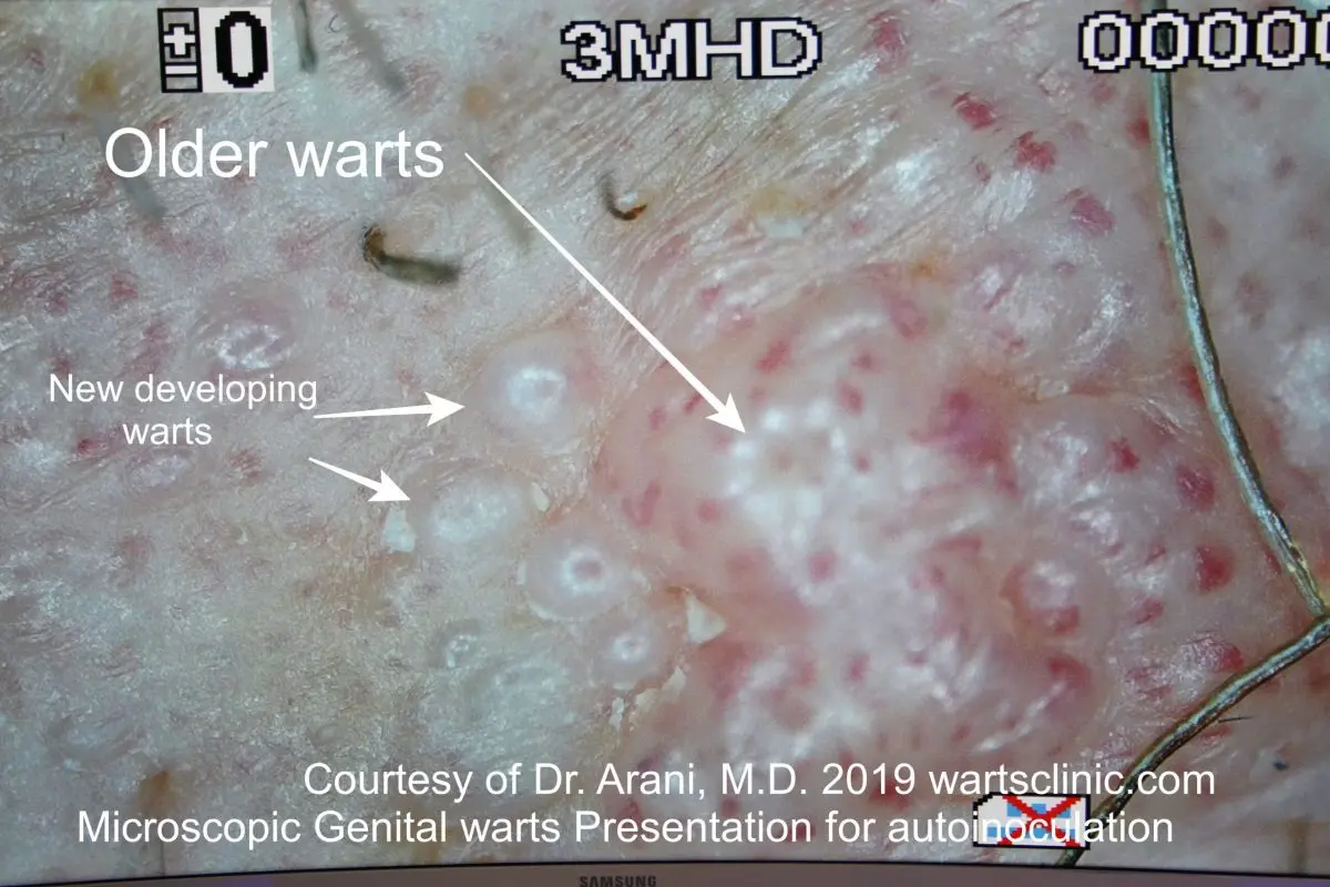 Condylomas (genital warts)