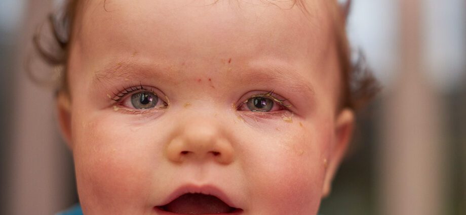 Conjunctivitis in a newborn: how to cure? Video