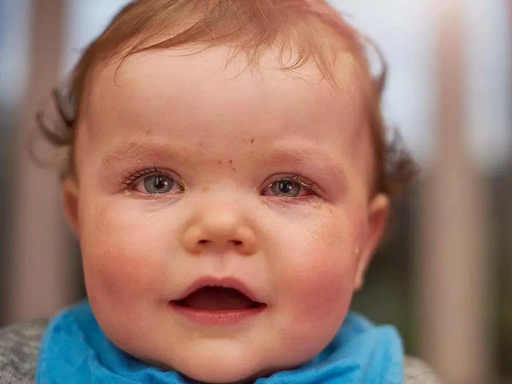 Conjunctivitis in babies: what to do?