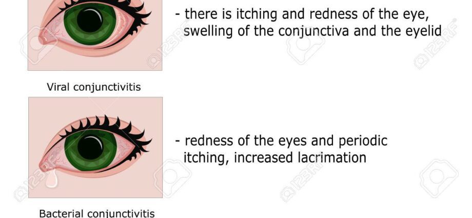 Conjunctivitis: symptoms and treatment