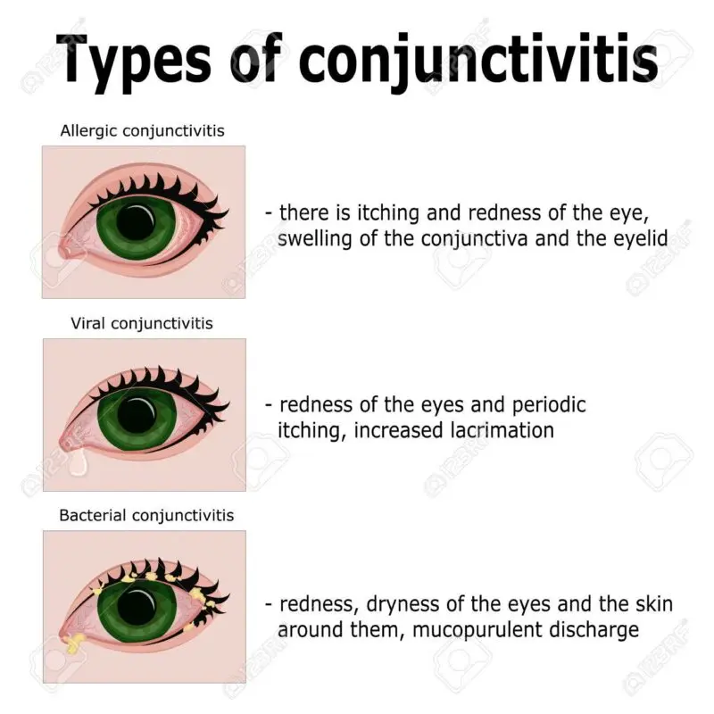 Conjunctivitis: symptoms and treatment