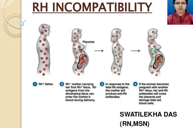 Consequences of the Rh-conflict between mother and fetus