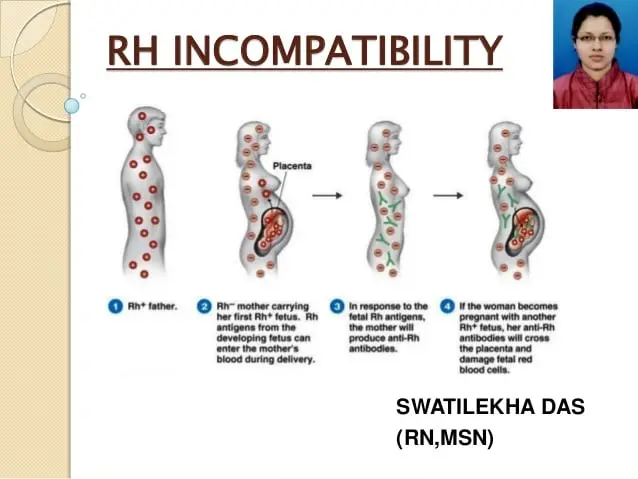 Consequences of the Rh-conflict between mother and fetus