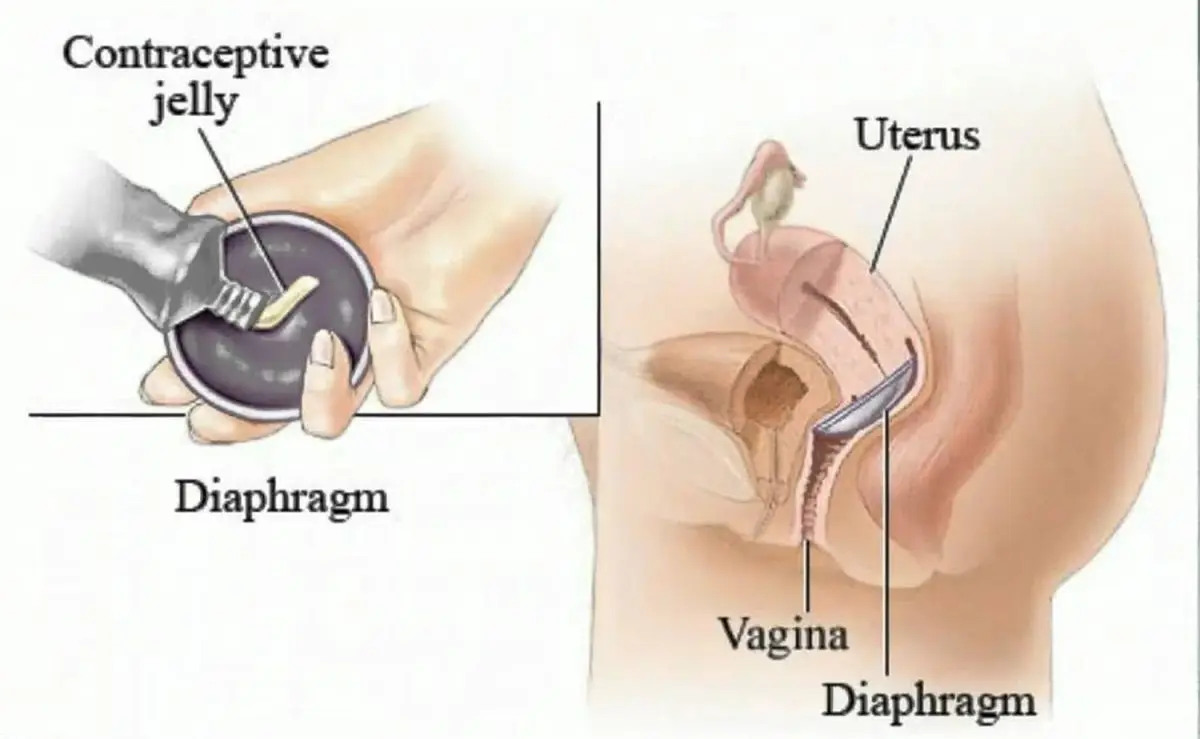 Contraceptive diaphragm: how is the installation of this contraceptive carried out?