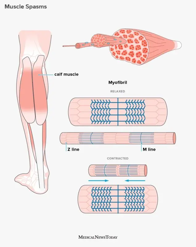 Convulsions: where do these muscle spasms come from?