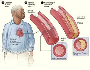 Coronary artery: can you live with a blocked artery?