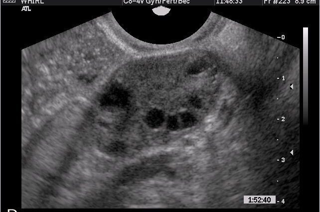 Žuto tijelo u lijevom jajniku sa zakašnjenjem, što znači ultrazvuk