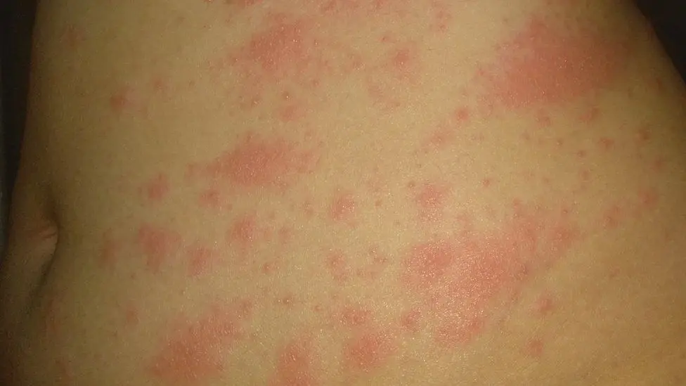 Covid-19: the appearance of redness, a skin symptom of the coronavirus?