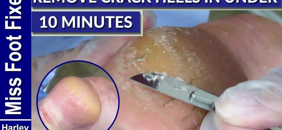 Cracked heels: how to treat? Video