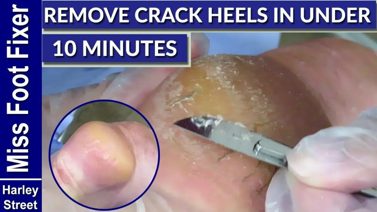 Cracked heels: how to treat? Video