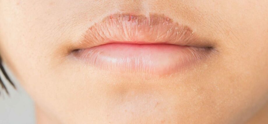 Cracked lips: what to do?