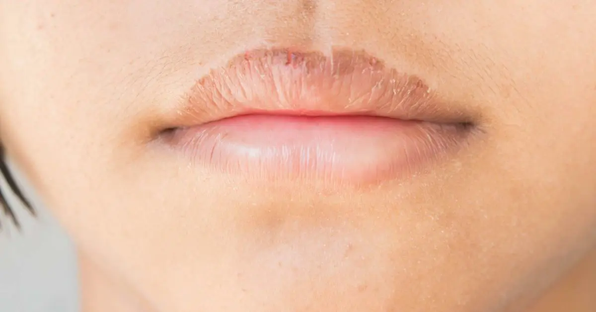 Cracked lips: what to do?