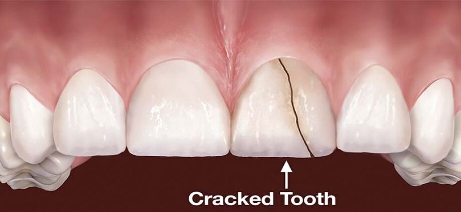 Cracked tooth: what to do